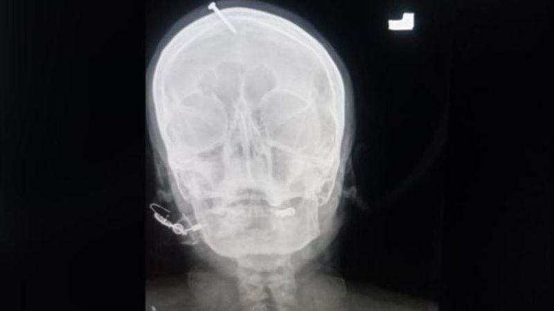 Pakistan'da hamile kadının kafasına erkek çocuk için çivi çaktılar