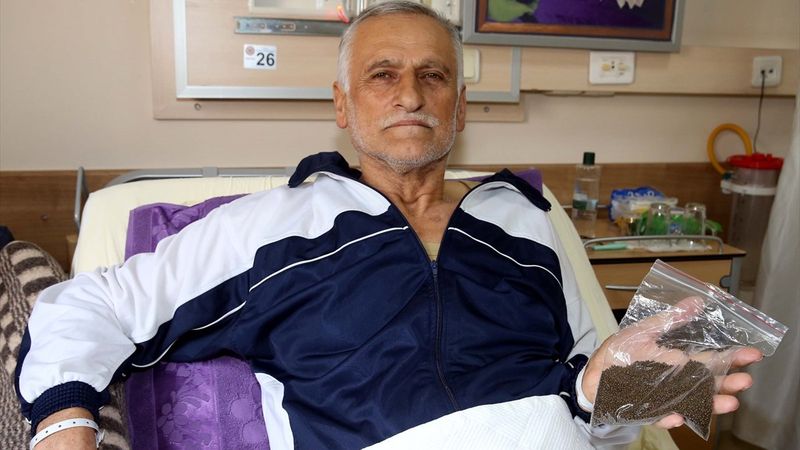 Tokat'ta safra kesesinden 14 bin 387 taş çıkarıldı