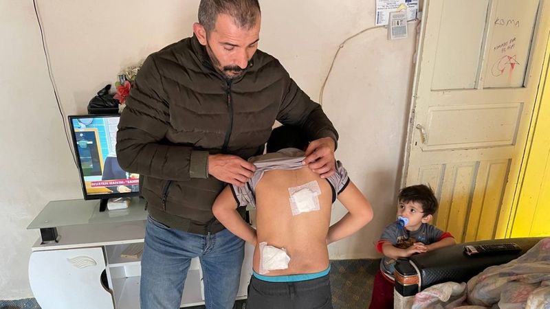 Sivas'ta başıboş köpekler çocuğa saldırdı