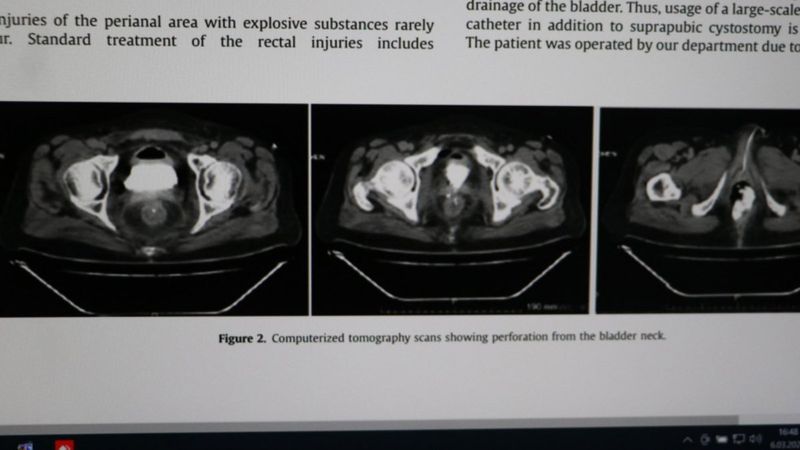 Denizli'de makatına torpil yerleştirip patlatan kişi, tıp literatürüne girdi