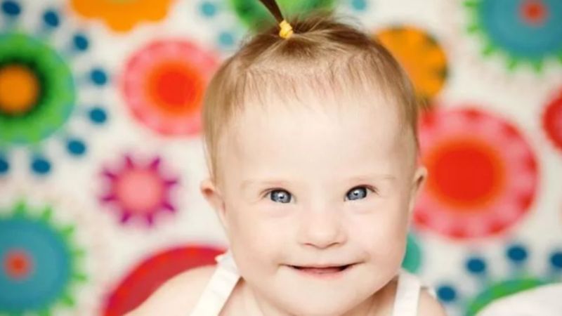 Down sendromu, çocuklarda göz sağlığını etkiliyor