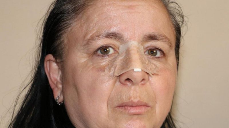 Eskişehir'de birlikte yaşadığı sevgilisi burnunu kırdı