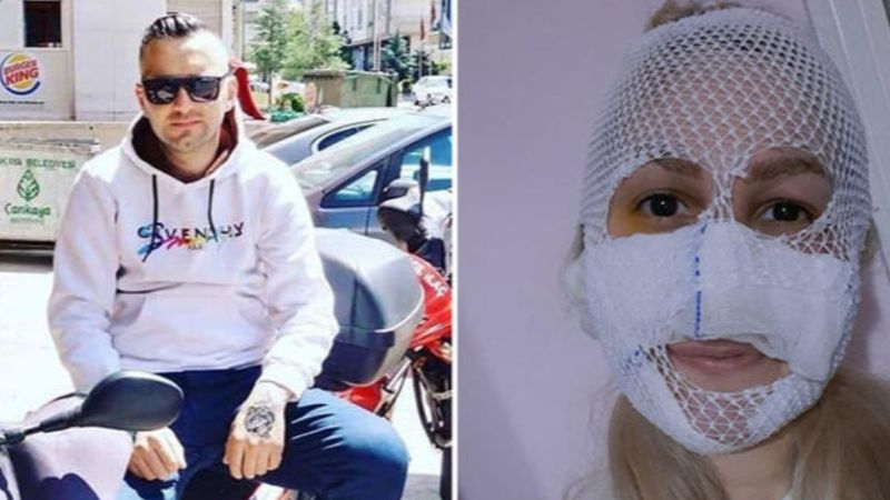 Ankara'da Sultan'ın yüzüne kimyasal madde atan şahıs yakalandı