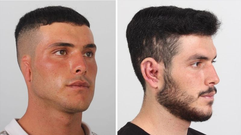 Karaman'da göğüs kafesi dokusundan kulak yapıldı