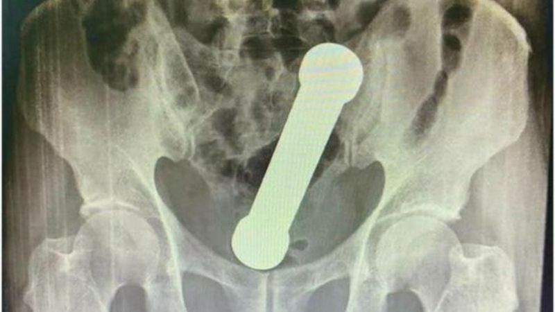 Brezilya'da yaşlı adam, makatına soktuğu dambılı çıkaramadı