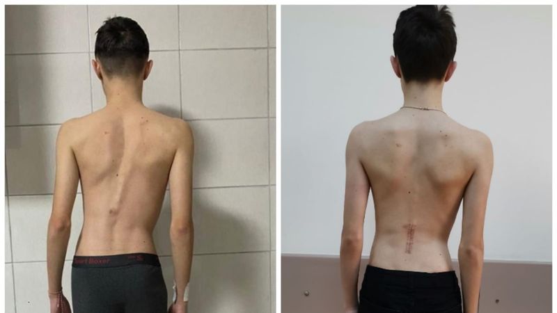 Sakarya'da, bisiklet kazasıyla kemiklerindeki eğriliği fark etti