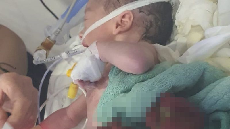 Elazığ'da, bağırsakları dışarıda doğan bebek ameliyatla sağlığına kavuştu