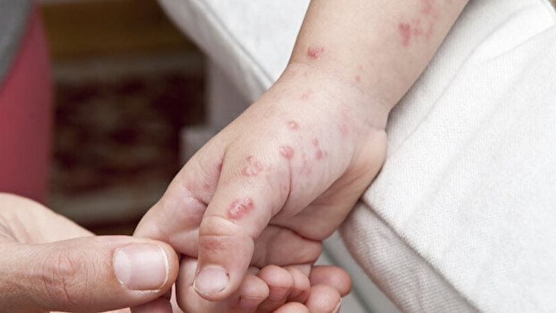 Irak'ta, maymun çiçeğine karşı bazı kentlere maymun getirilmesi yasaklandı