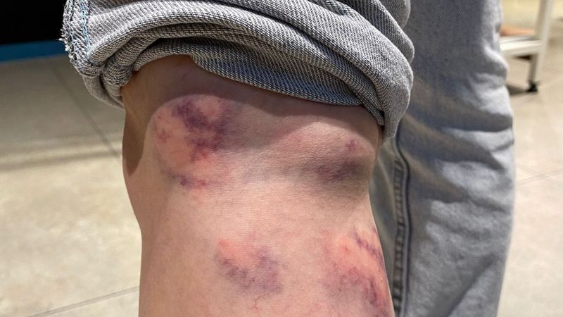 Zonguldak'ta sokak köpekleri genç kadını yaraladı