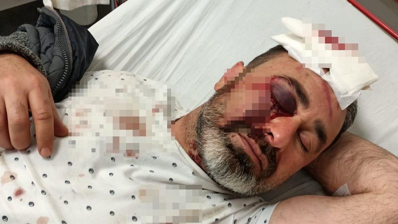 Burdur'daki kavgayı ayırmak isteyen şahsın retinası parçalandı