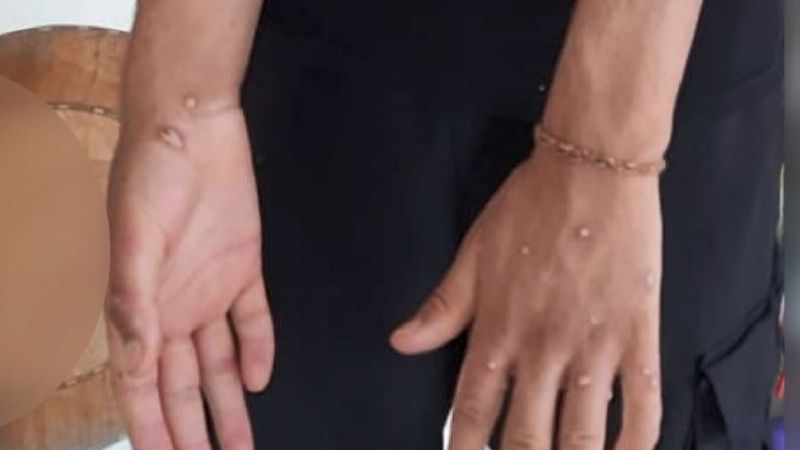 Sultangazi'de maymun çiçeği şüphesi