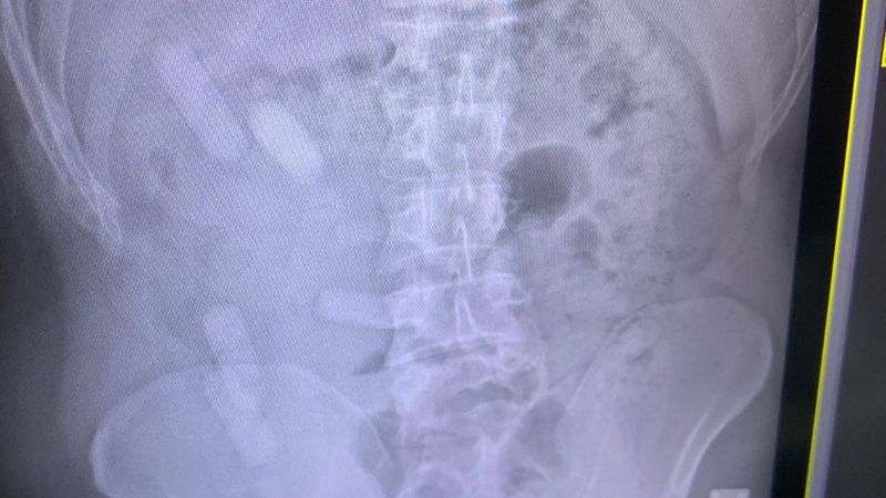 Sivas'taki İranlı yolcunun midesinden uyuşturucu çıktı