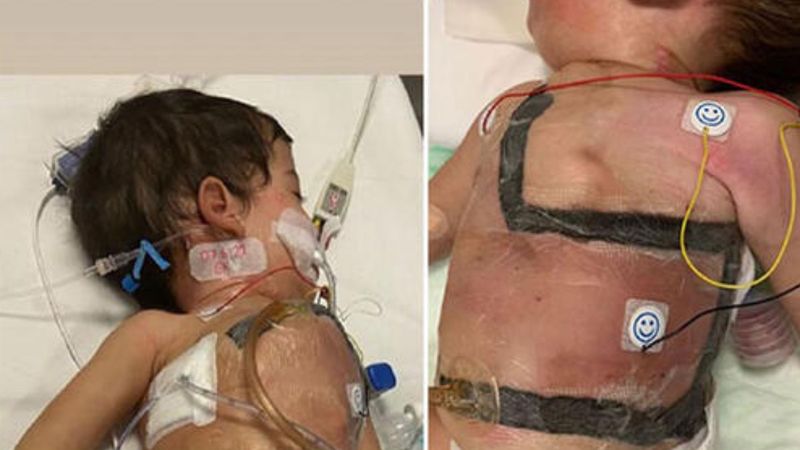 Cezayirli siyam ikizleri İstabul'da ayrıldı