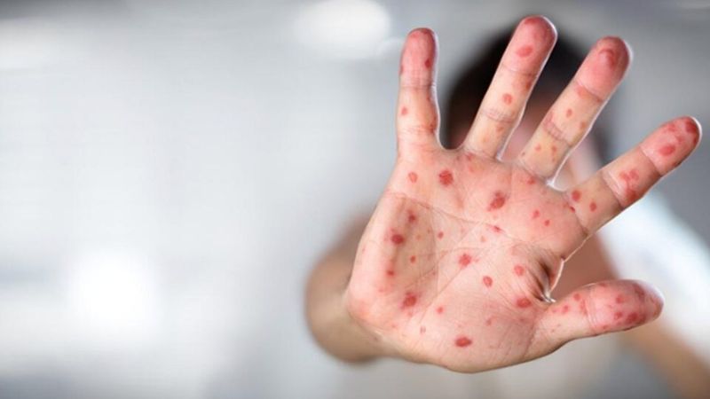 Maymun çiçeği virüsünün ismi ırkçılık riskinden dolayı değiştiriliyor