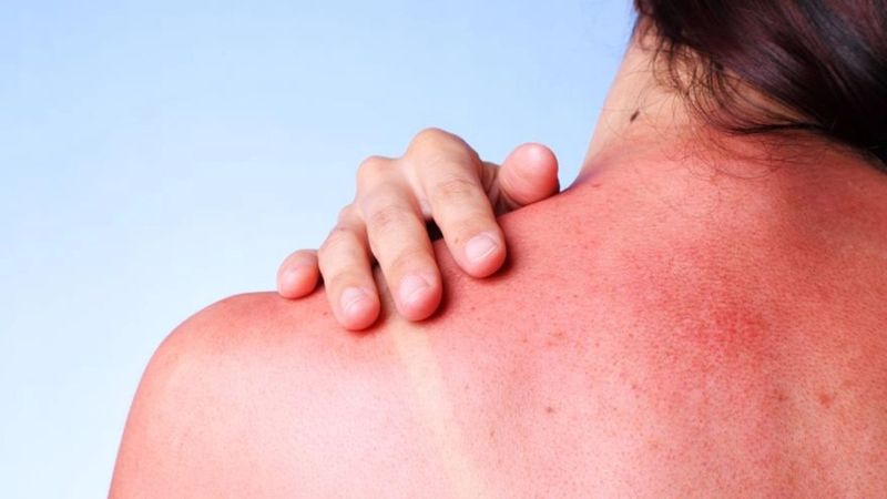 Güneşlendikten sonra bunu mutlaka yapın! Etkisi inanılmaz...