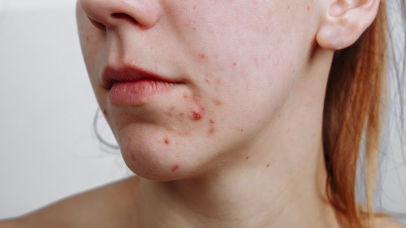 Sivilceye karşı ne yenir ve nelerden kaçınılır? Sivilceleri azaltmaya yardımcı olan 5 yiyecek...