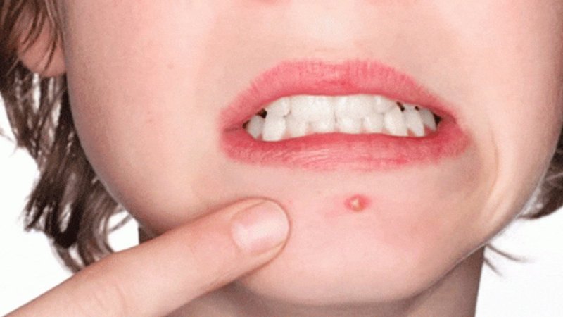 Çenede neden sivilce çıkar? Çenede çıkan sivilceyi doğal yöntemler ile nasıl yok edebiliriz?