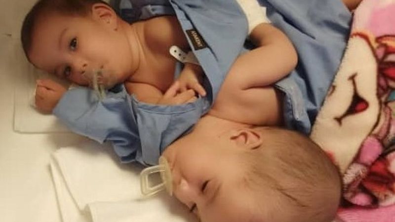 Ameliyatla ayrılan siyam ikizleri, taburcu edildi
