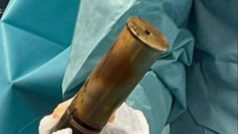 Fransa'da, 88 yaşındaki adamın makatından top mermisi çıkarıldı