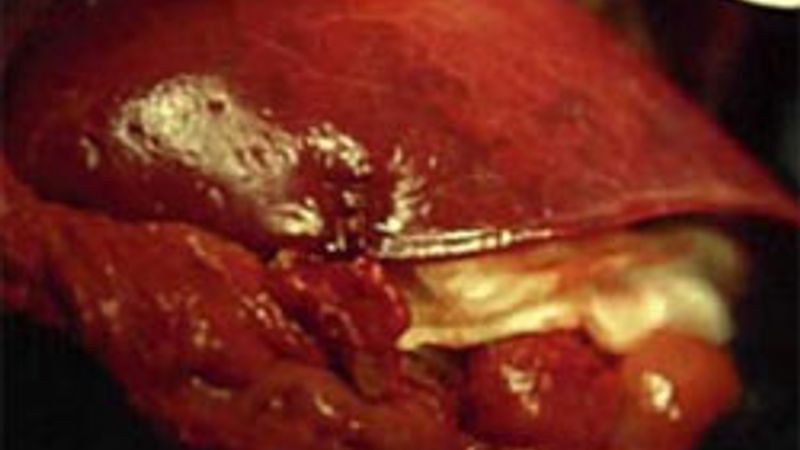 Karaciğer kisti ile ilgili tüm bilinmeyenler