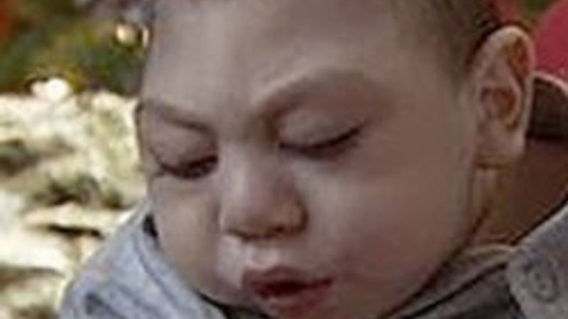 Beyni olmadan 3 yıl yaşadı