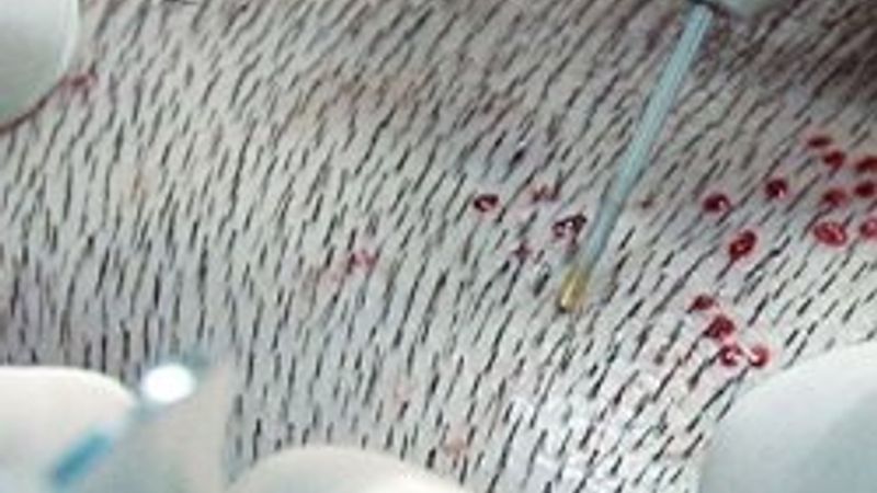 Saç ekiminde başarı yükseliyor