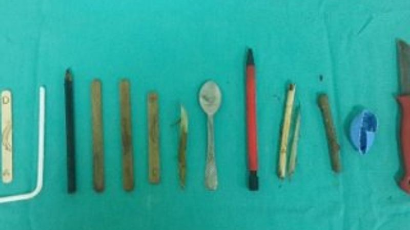 Çocuğun midesinden 15 parça yabancı cisim çıktı