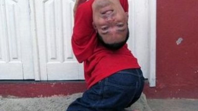 Brezilya'da boynu ters doğan adam 37 yaşında