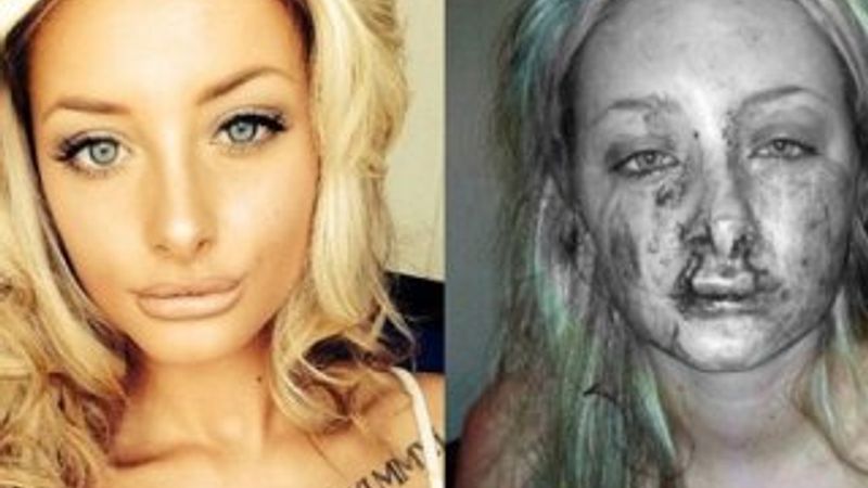 Kıskanç genç sevgilisinin üst dudağını kopardı