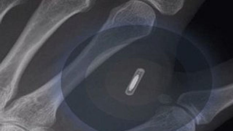 Avustralya'da bir kişi iPhone için eline çip taktırdı