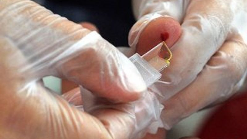 Kistik fibrozise tarama testli çözüm