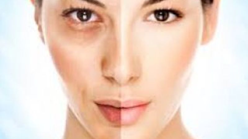 Cilt lekesi olanlar dikkat