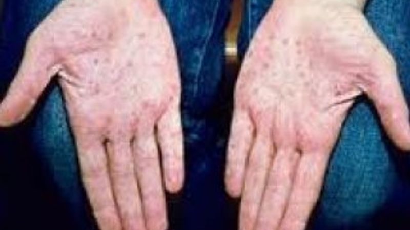 Sedef hastalığı için umut ışığı