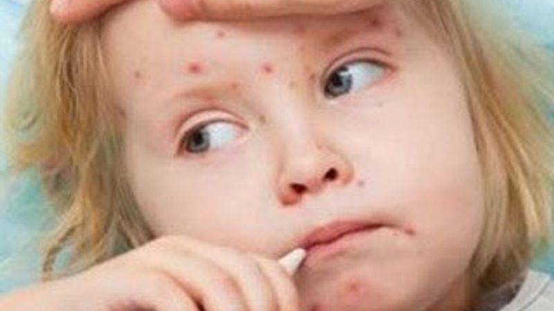 ABD'de kızamık salgını yayılıyor