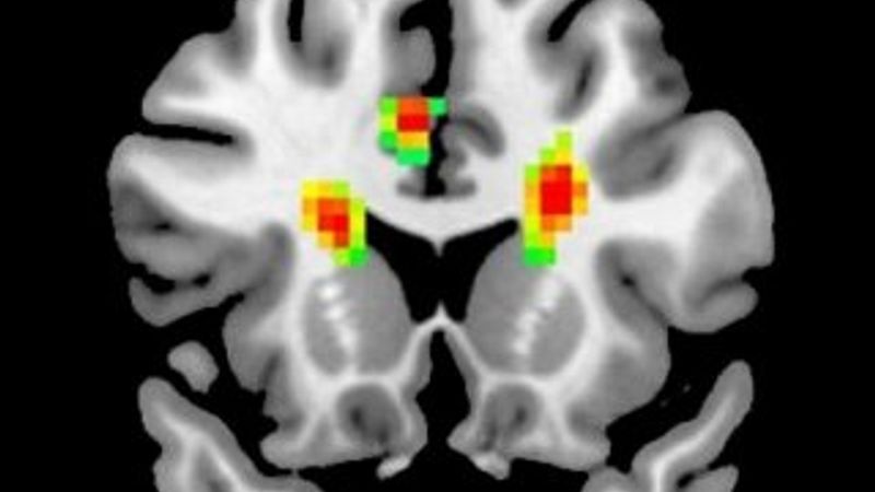 Aşık insanların beyin MR'ı çekildi