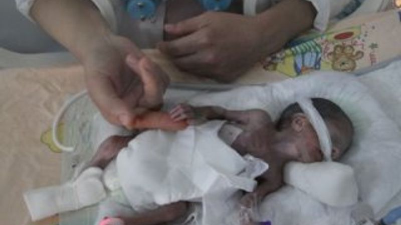 500 gram doğan parmak bebek hayata tutundu