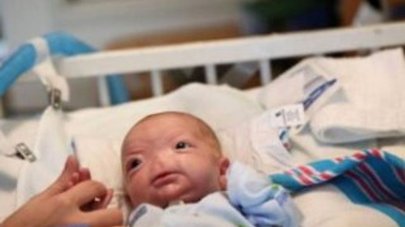 Alabama'da burunsuz bir bebek doğdu