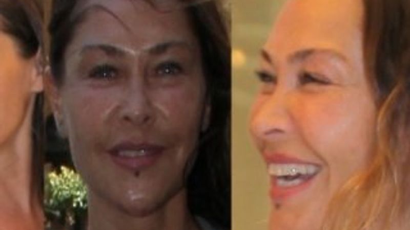 Hülya Avşar yüzüne dolgu yaptırdı