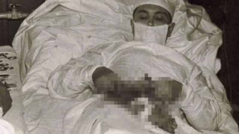 Kendi apandisit ameliyatını yaparak tarihe geçen doktor