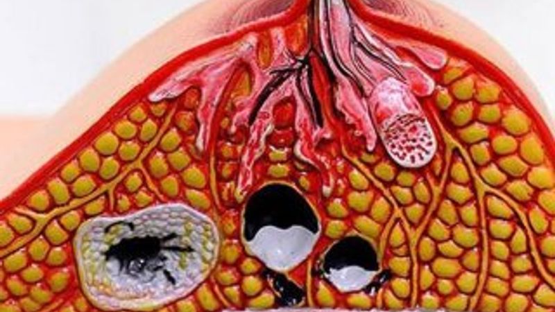 Yoğurt meme kanseri riskini azaltıyor