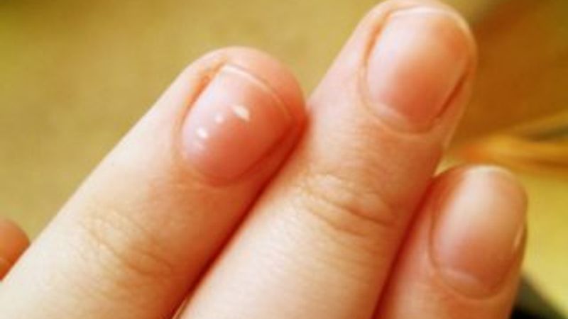 Tırnaklardaki beyaz lekenin nedeni ve çözümü