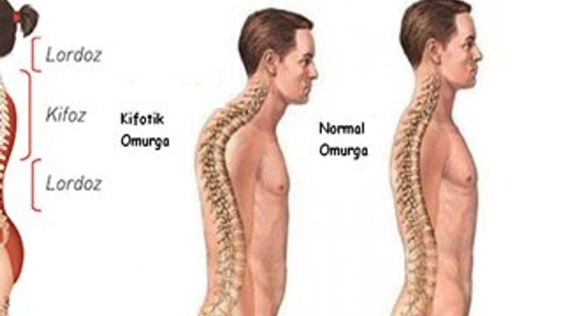 Lordoz nedir