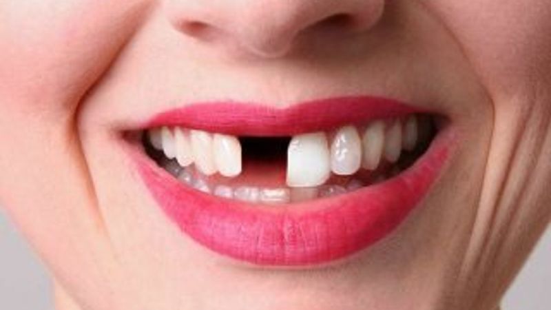 Öz güven için dişlerin tamamı gerekli
