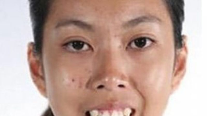 Taylandlı kadının ameliyat sonrası muhteşem değişimi