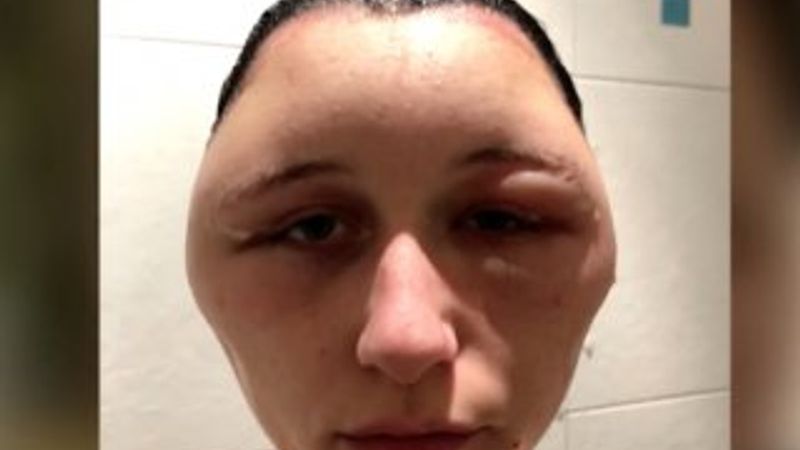 Saç boyasına alerjisi olan kadın yaşamını yitiriyordu