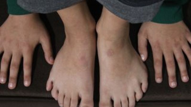 24 parmaklı çocuğun yaşam mücadelesi