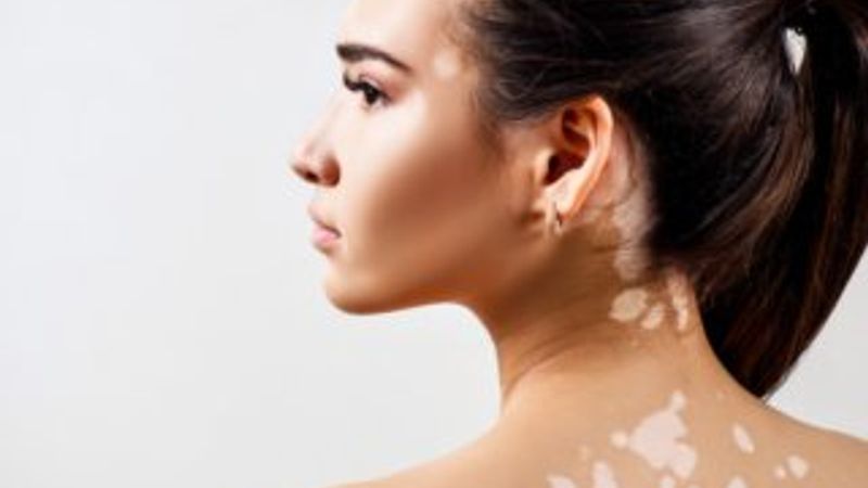 Vitiligo nedir