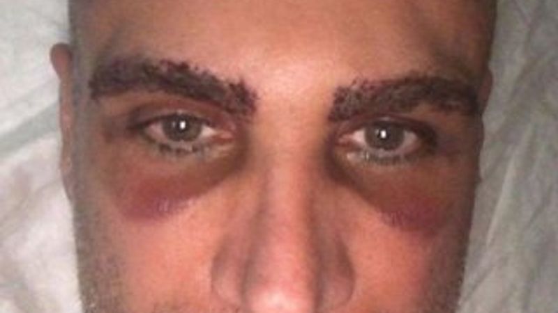 Doğuş hem kaşını hem saçını ektirdi