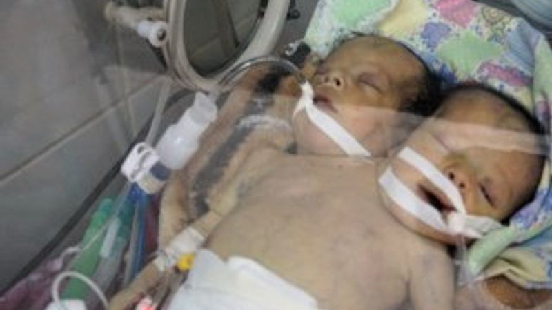 Yemenli yapışık ikizler kurtarılamadı