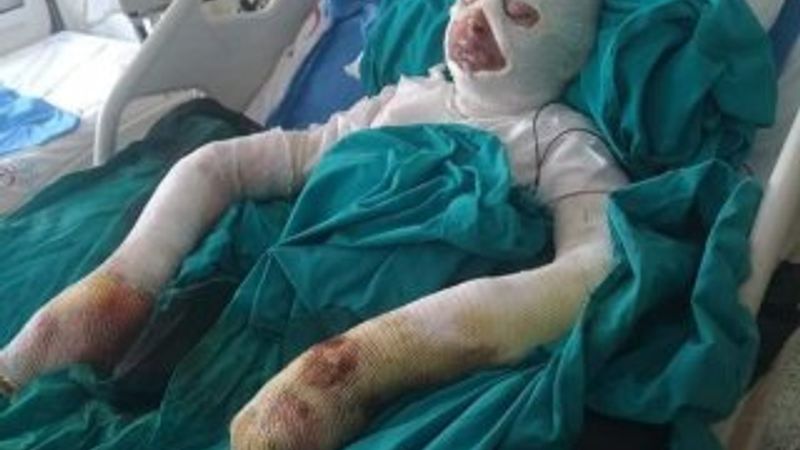 Lise öğrencisi bitlerden kurtulmak isterken tutuştu